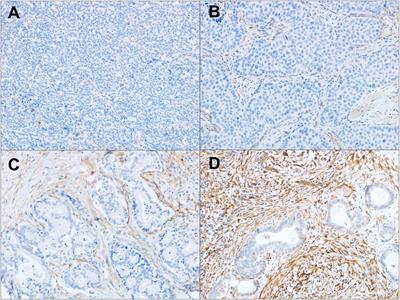 Immunohistochemical basis for FAP as a candidate theranostic target across a broad range of cholangiocarcinoma subtypes